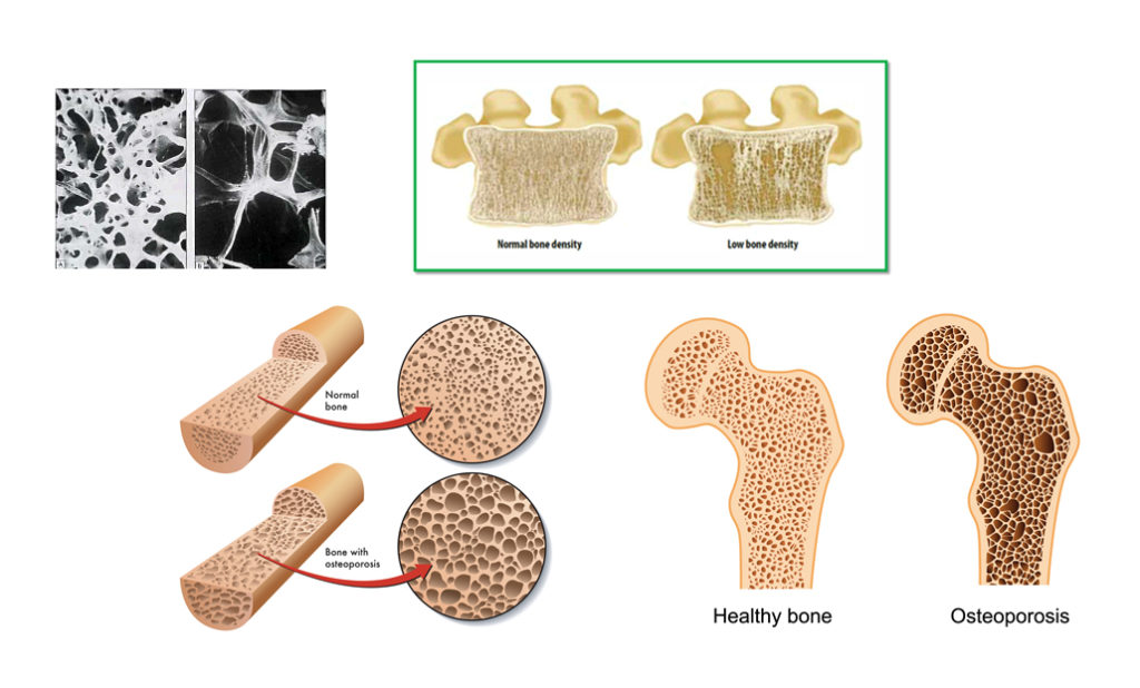 Understanding Bone Density Tests Can Help Prevent Further Problems 8831