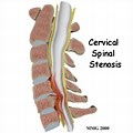 Cervical spinal stenosis anatomical illustration
