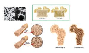 Healthy bone versus osteoporotic bone comparison